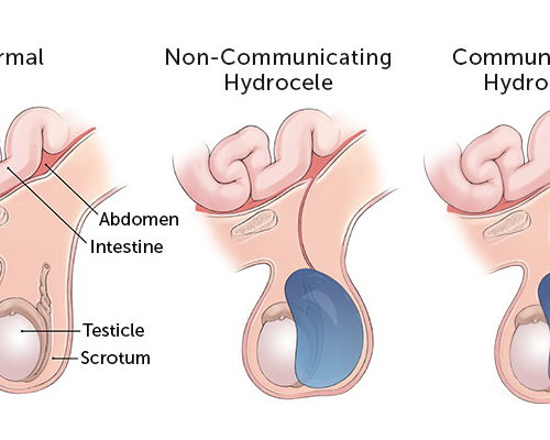 What Is the Best Treatment For Hydrocele?